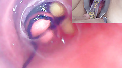 Mature Woman, Peehole Endoscope Camera in Bladder with Balls