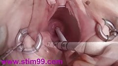 Extreme Real Cervix Fucking Insertion Objects in Utherus